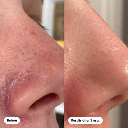 Hero Cosmetics Pore Release Blackhead Clearing Solution, Exfoliating 2% Salicylic Acid Toner Featuring AHA, BHA, and PHA, Blackhead Remover Toner, 100 ml